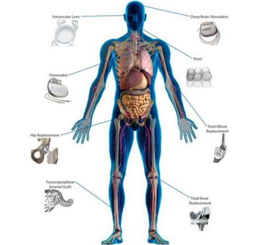 Silver hand Implantable devices trading